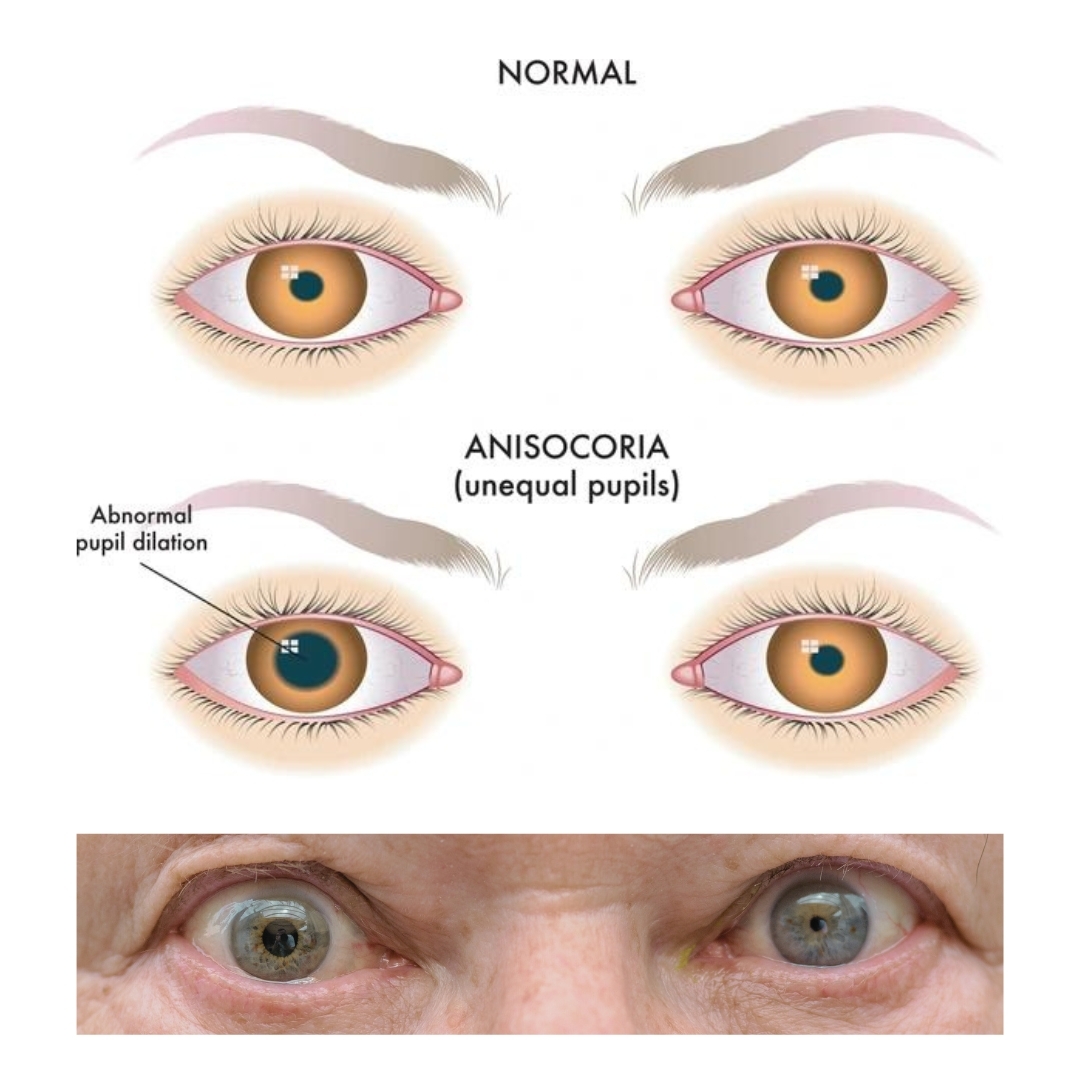 Anisocoria