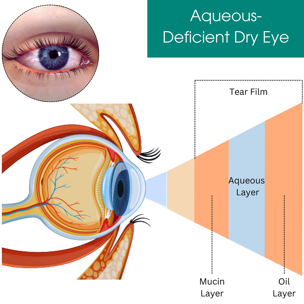 Aqueous-Deficient Dry Eye