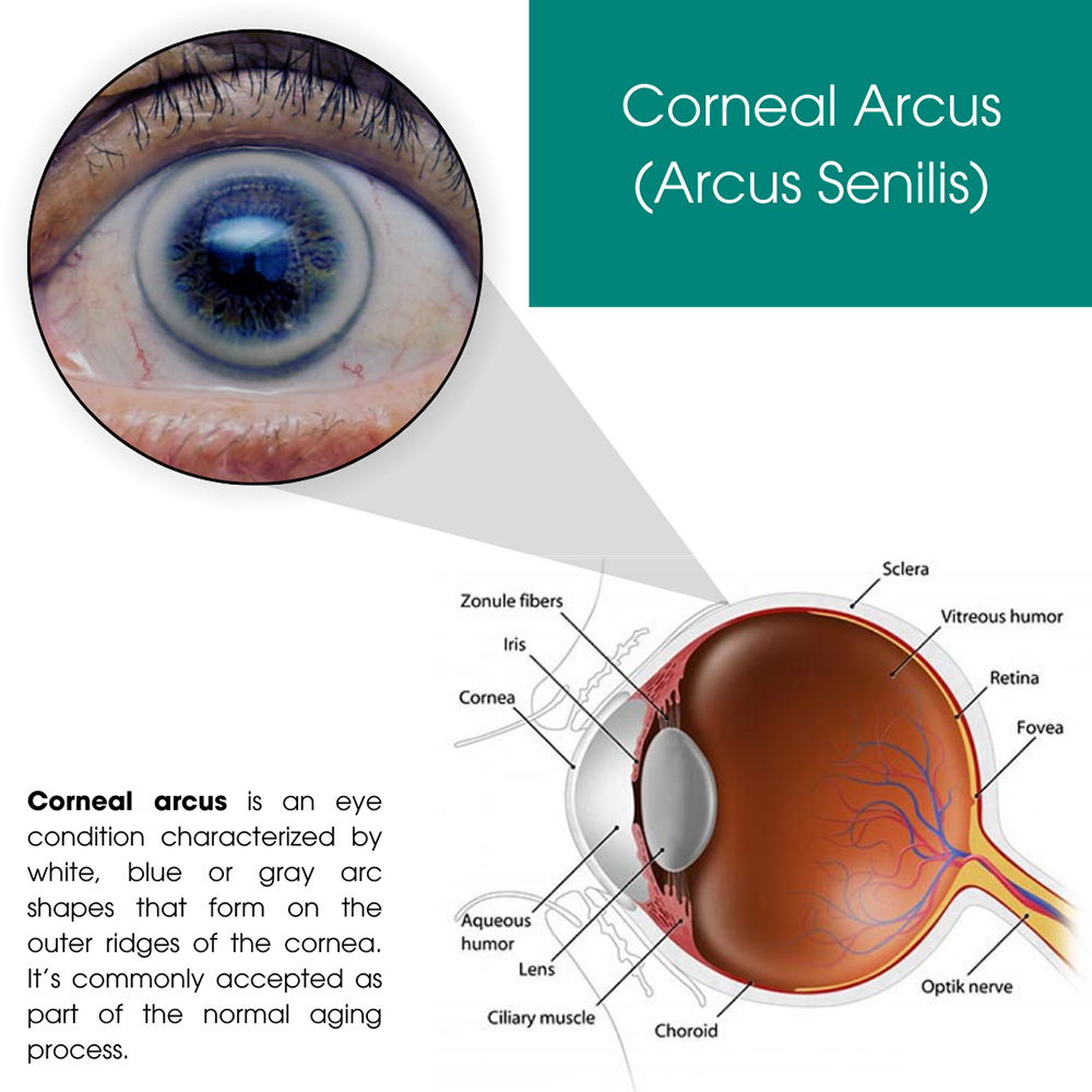 Corneal Arcus (Arcus Senilis)