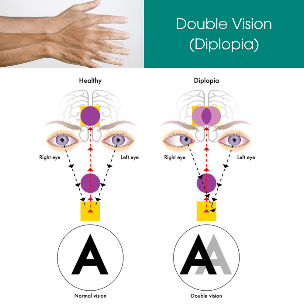 Double Vision (Diplopia)