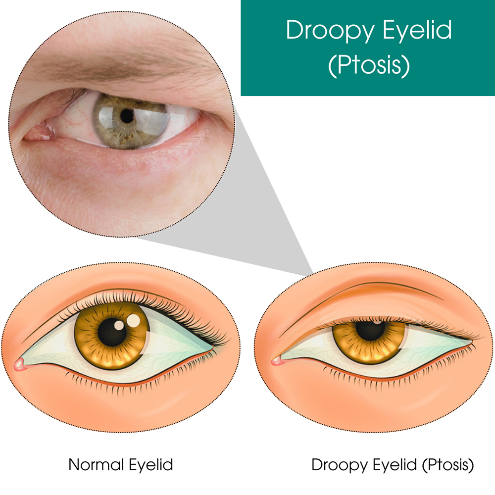 Droopy Eyelid (Ptosis)