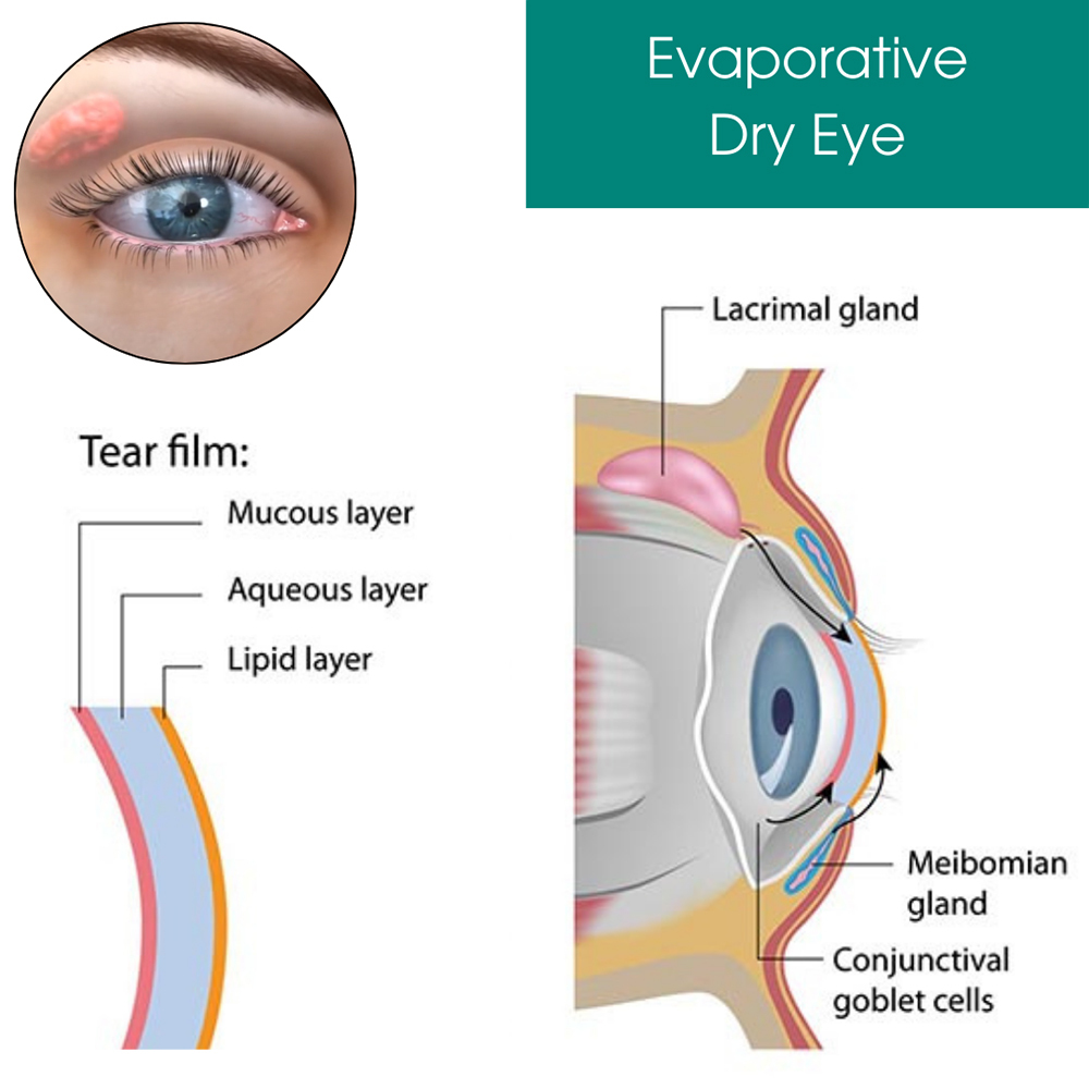 Evaporative Dry Eye