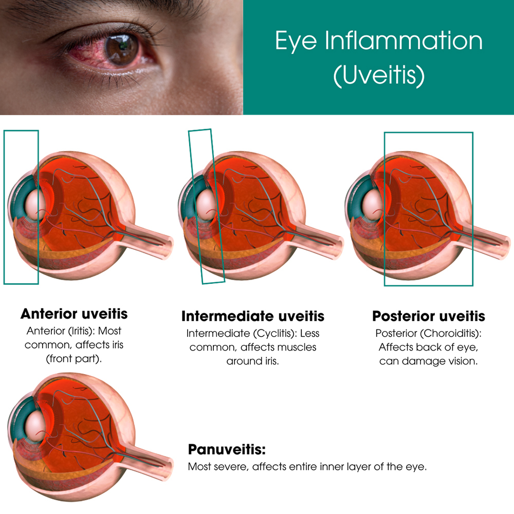 Eye Inflammation (Uveitis)