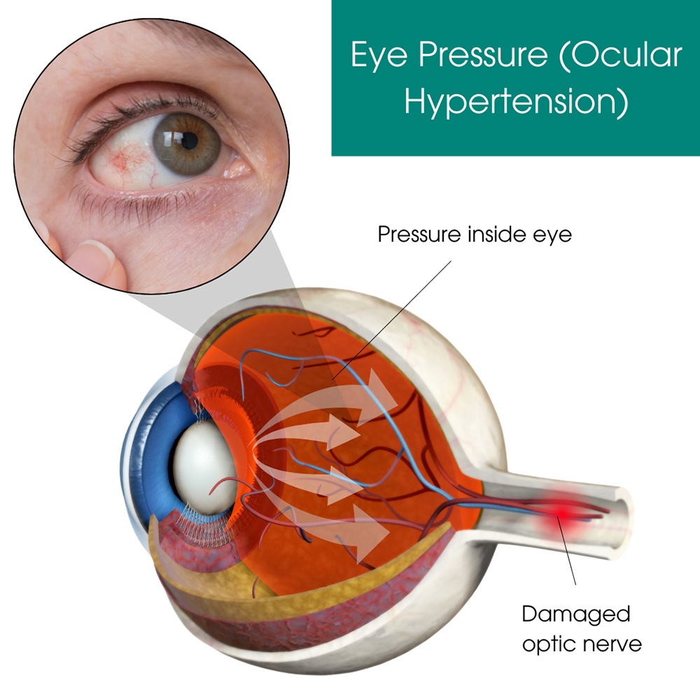 Eye Pressure (Ocular Hypertension)