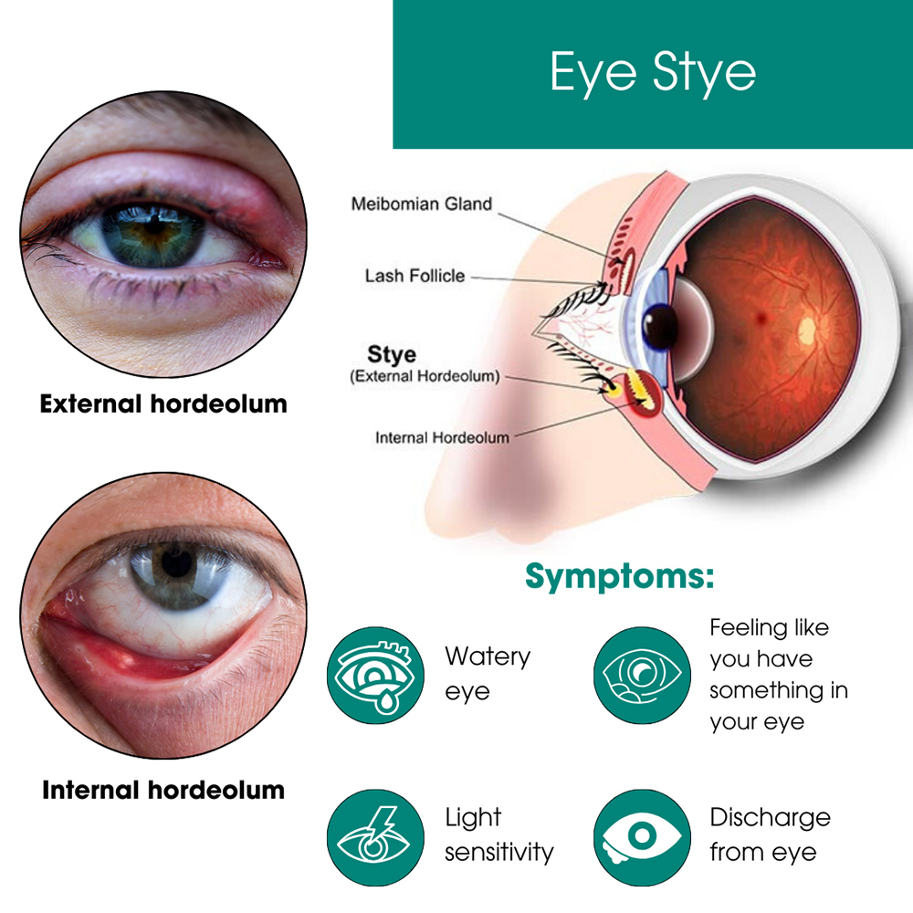 Eye Stye