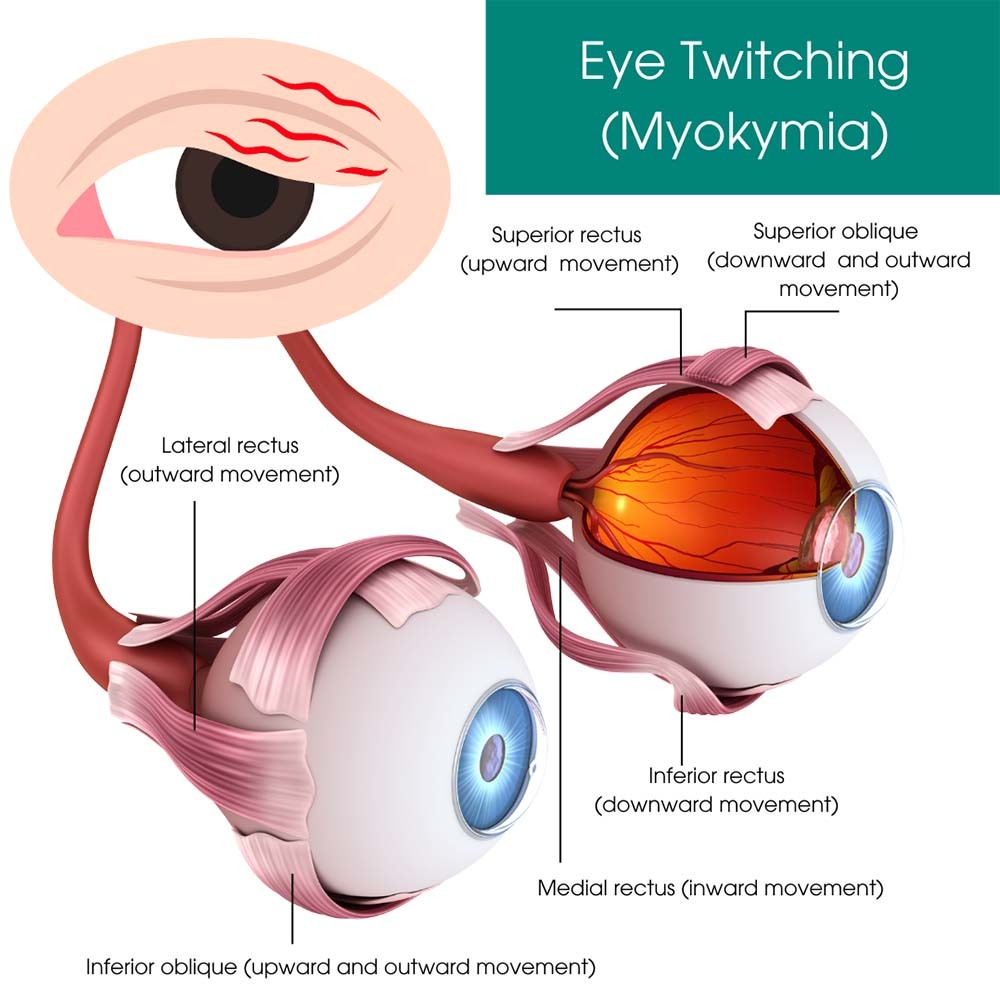 Eye Twitching (Myokymia)