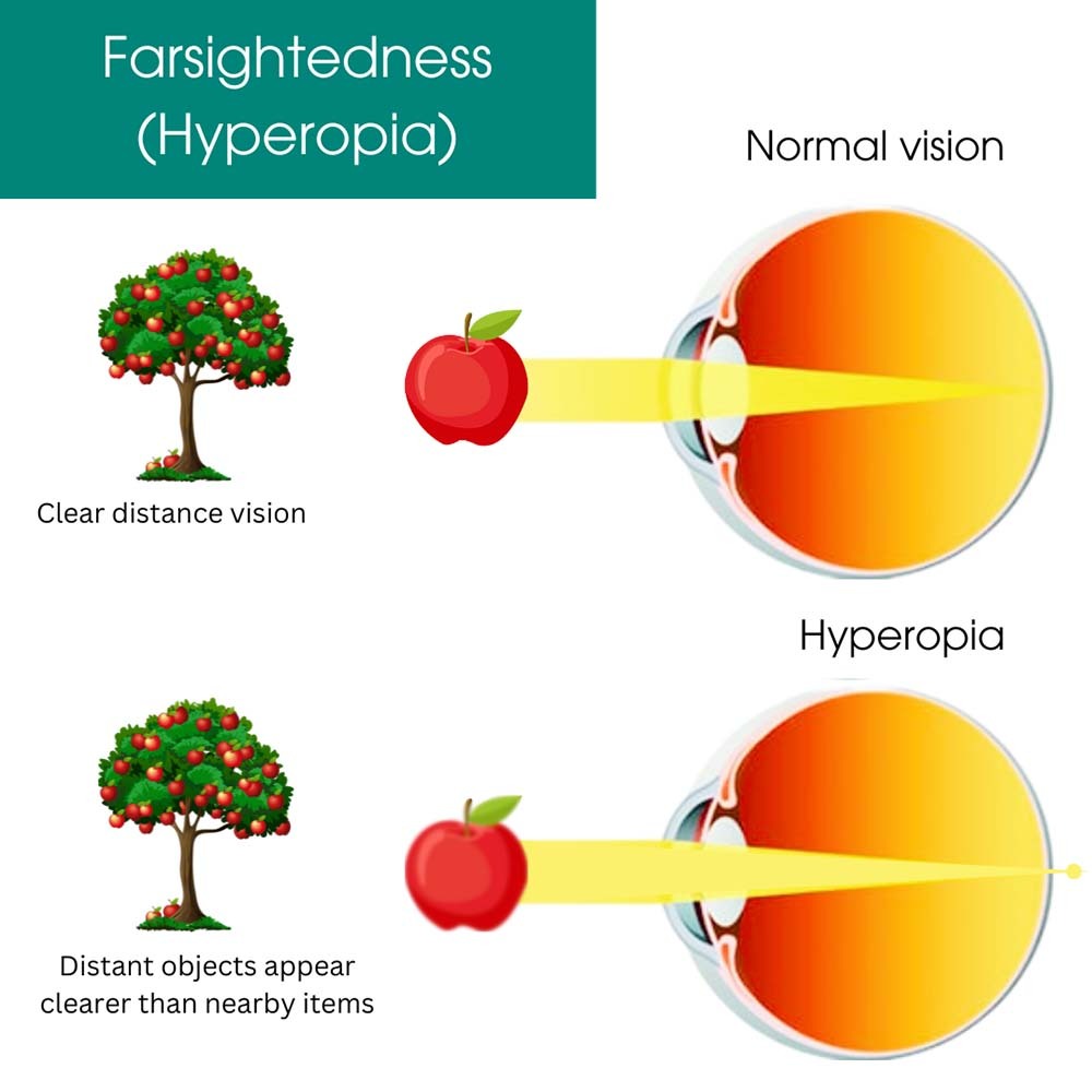 Farsightedness (Hyperopia) Treatment in Downtown Manhattan, NY | Eye ...