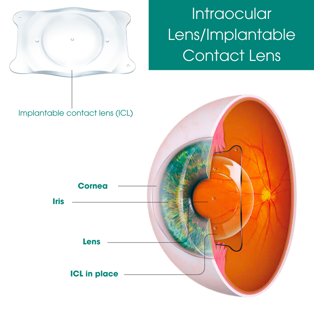 Intraocular Lens/Implantable Contact Lens