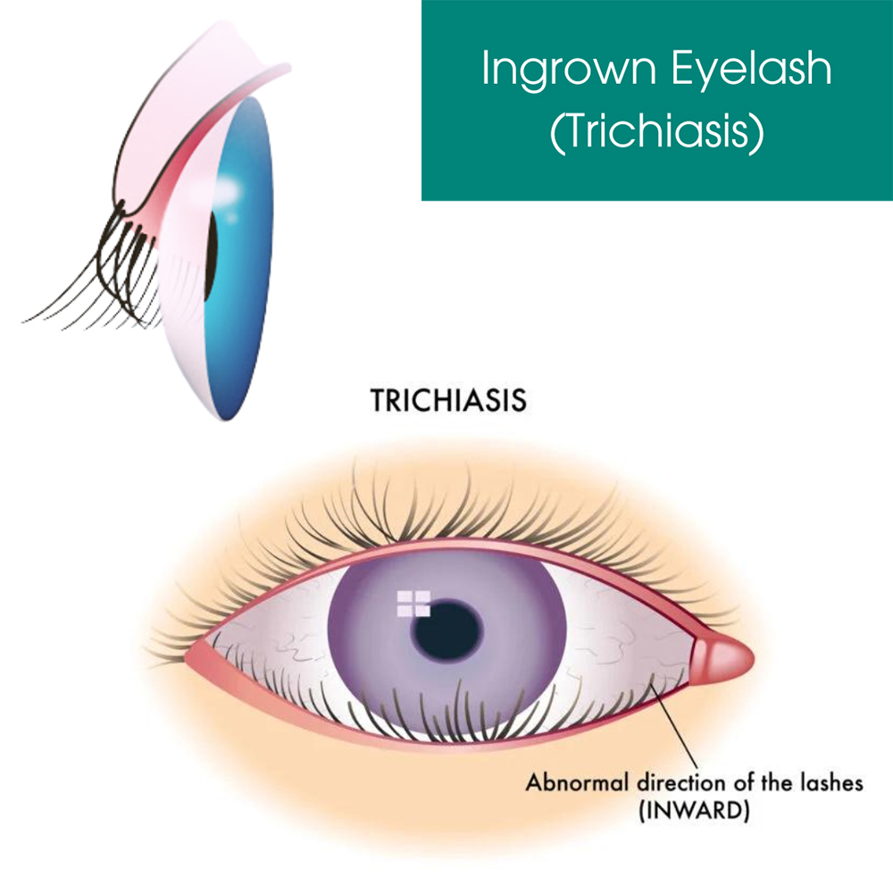 Ingrown Eyelash (Trichiasis)