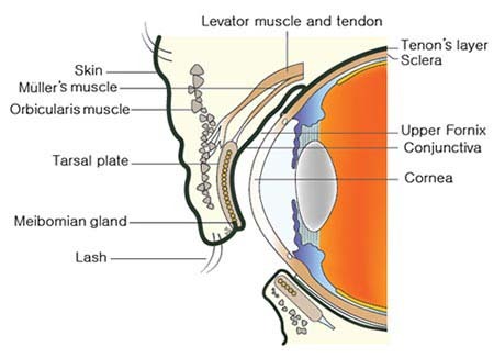 Inverted Eyelashes (Epiblepharon)