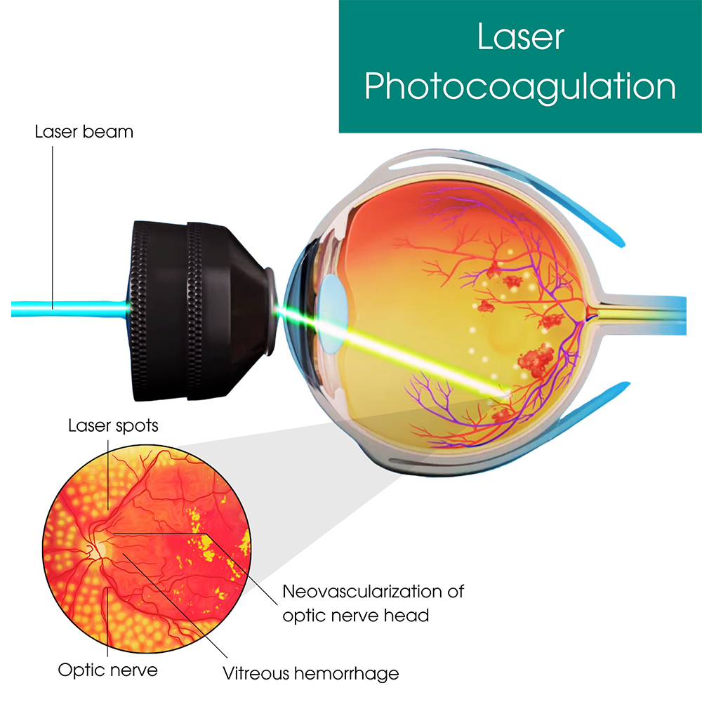 Laser Photocoagulation