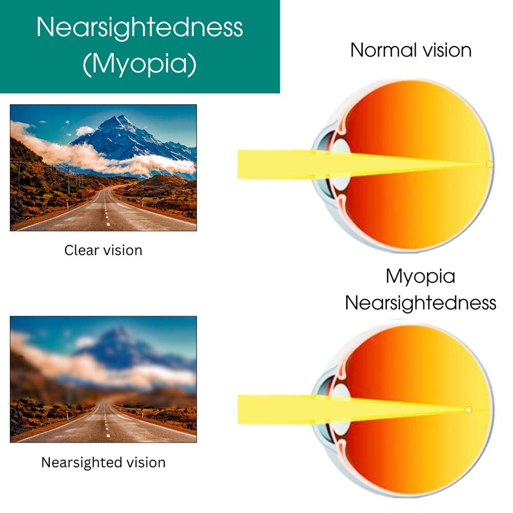 Nearsightedness (Myopia)