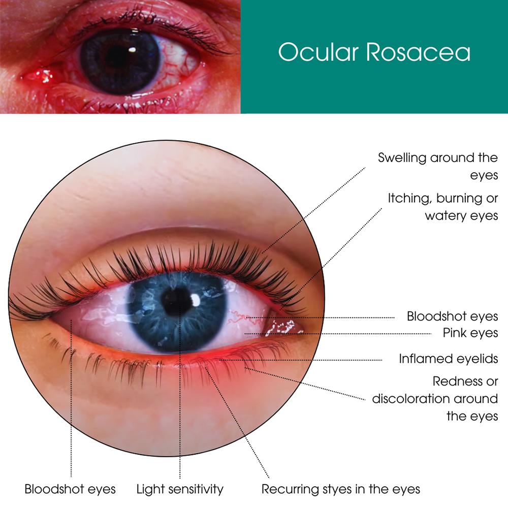 Ocular Rosacea Treatment NYC | Ocular Rosacea Specialist New York