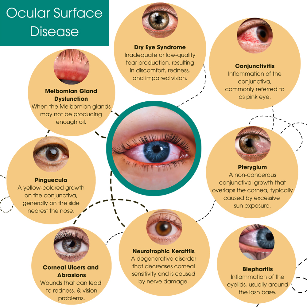 Ocular Surface Disease Treatment Downtown Manhattan, NY