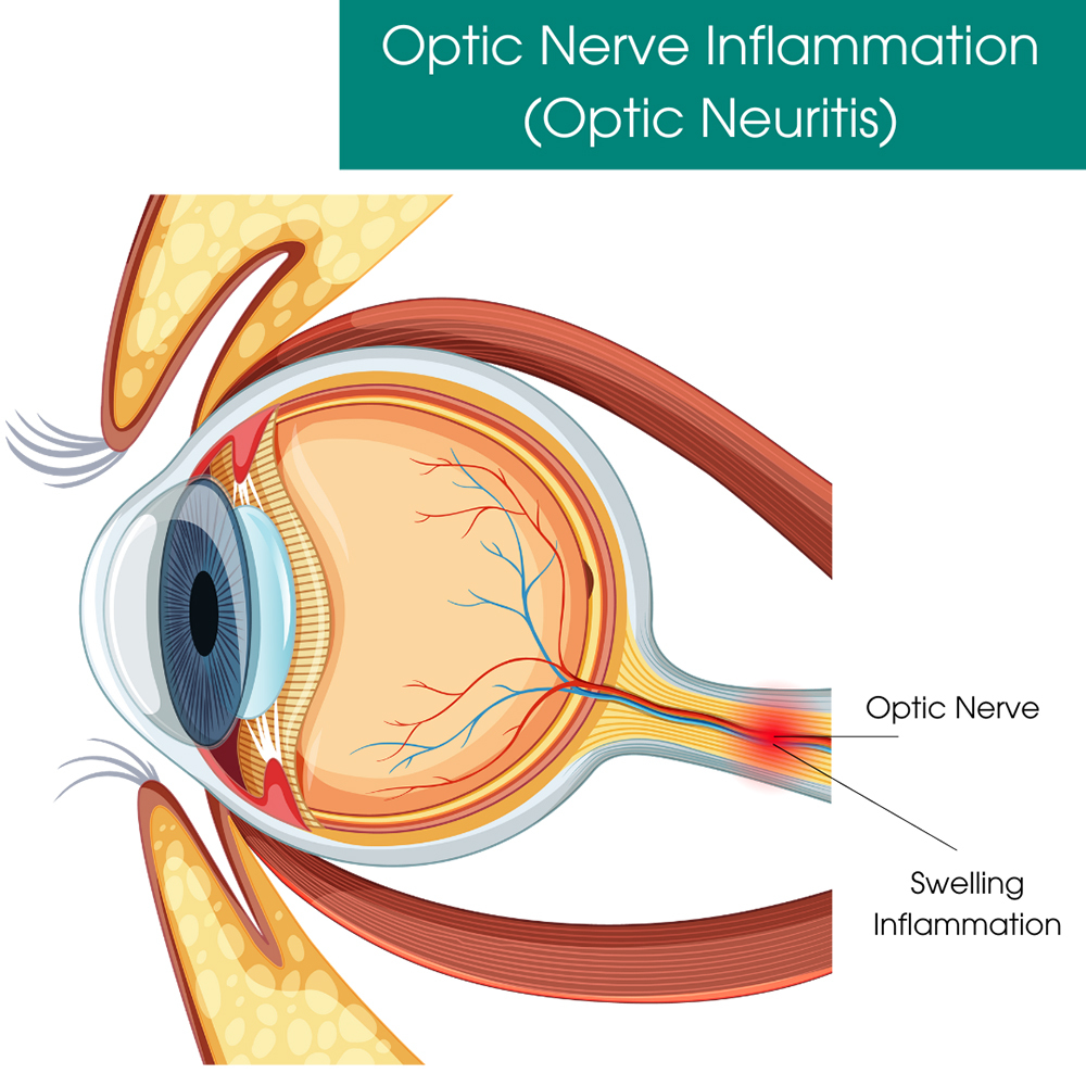 Optic Nerve Inflammation (Optic Neuritis)