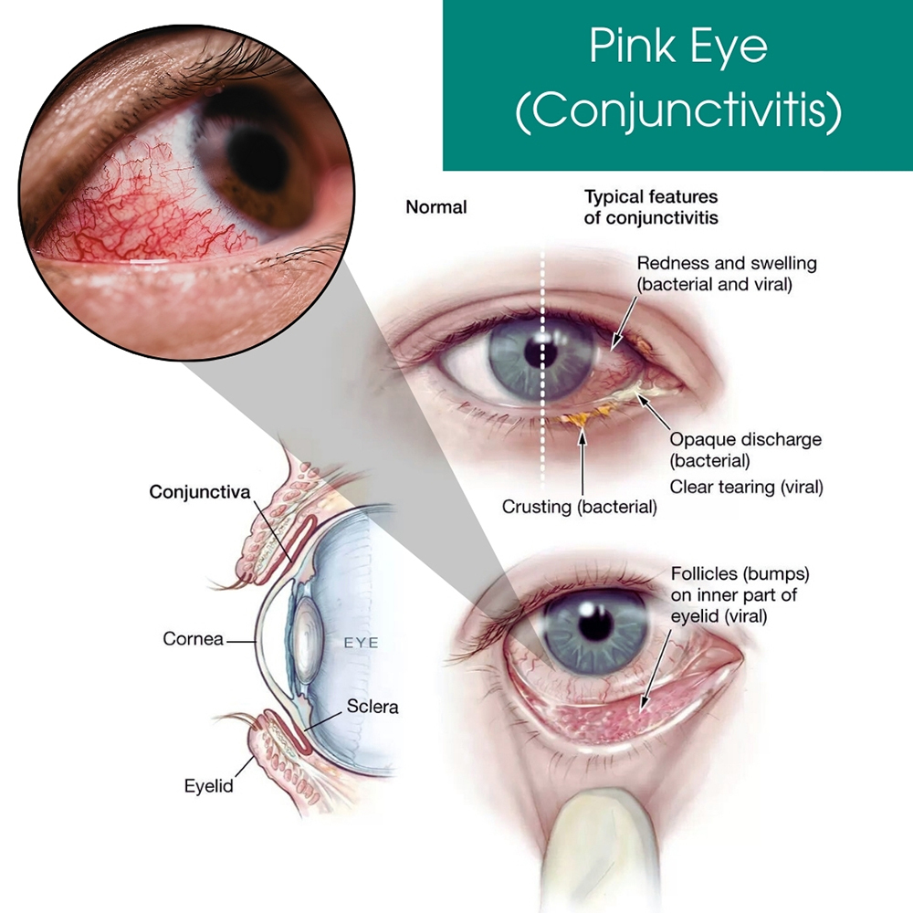 Pink Eye (Conjunctivitis)