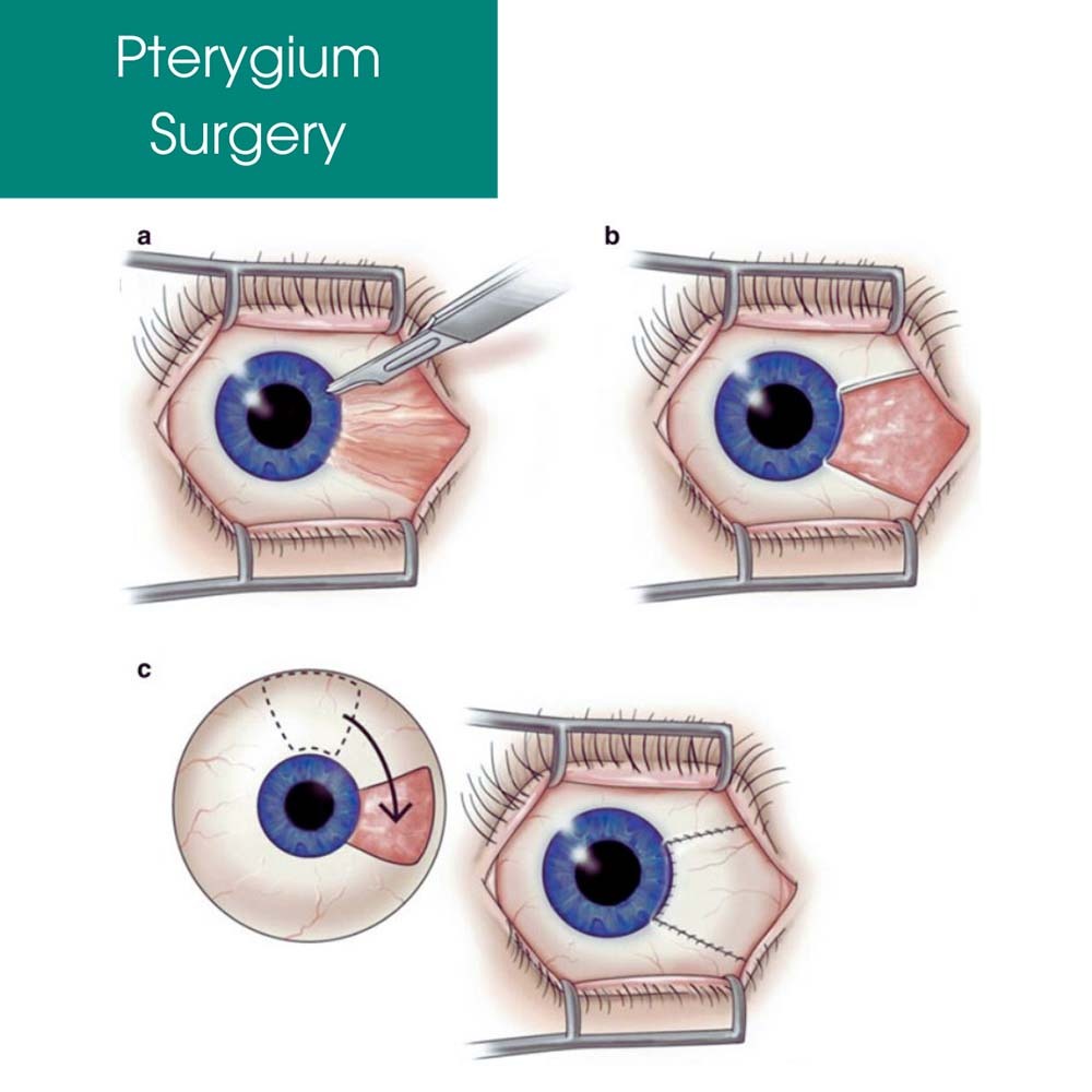 Pterygium Removal