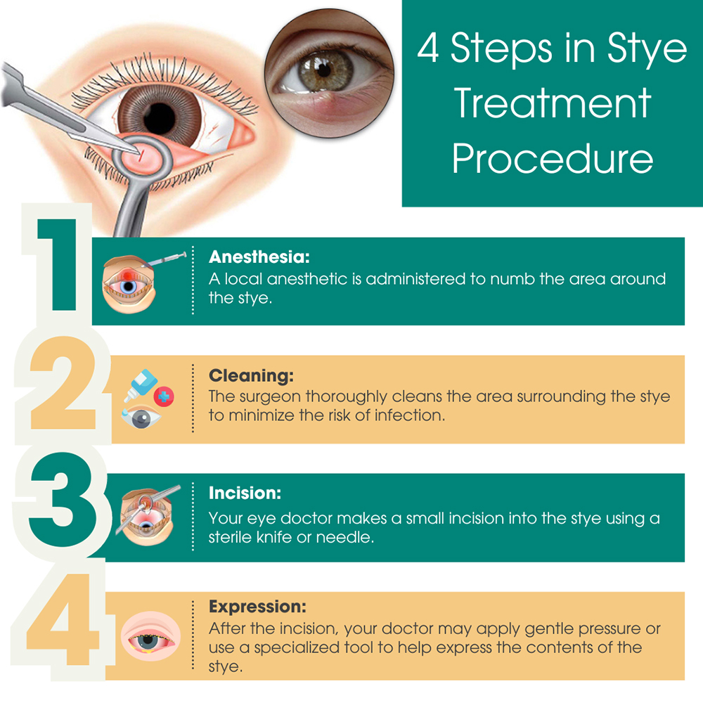 Steps in Stye Treatment Procedure