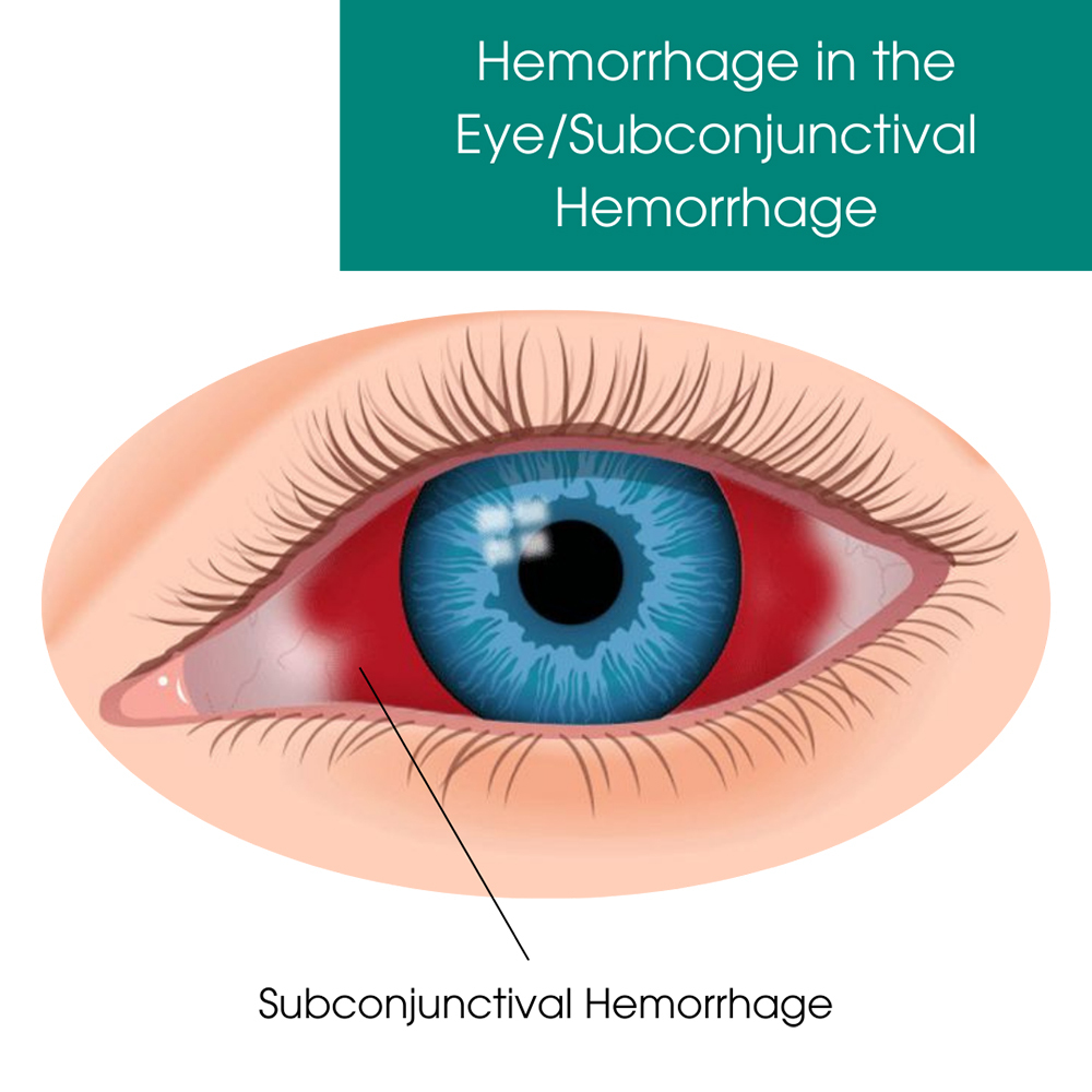 Hemorrhage in the Eye/Subconjunctival Hemorrhage