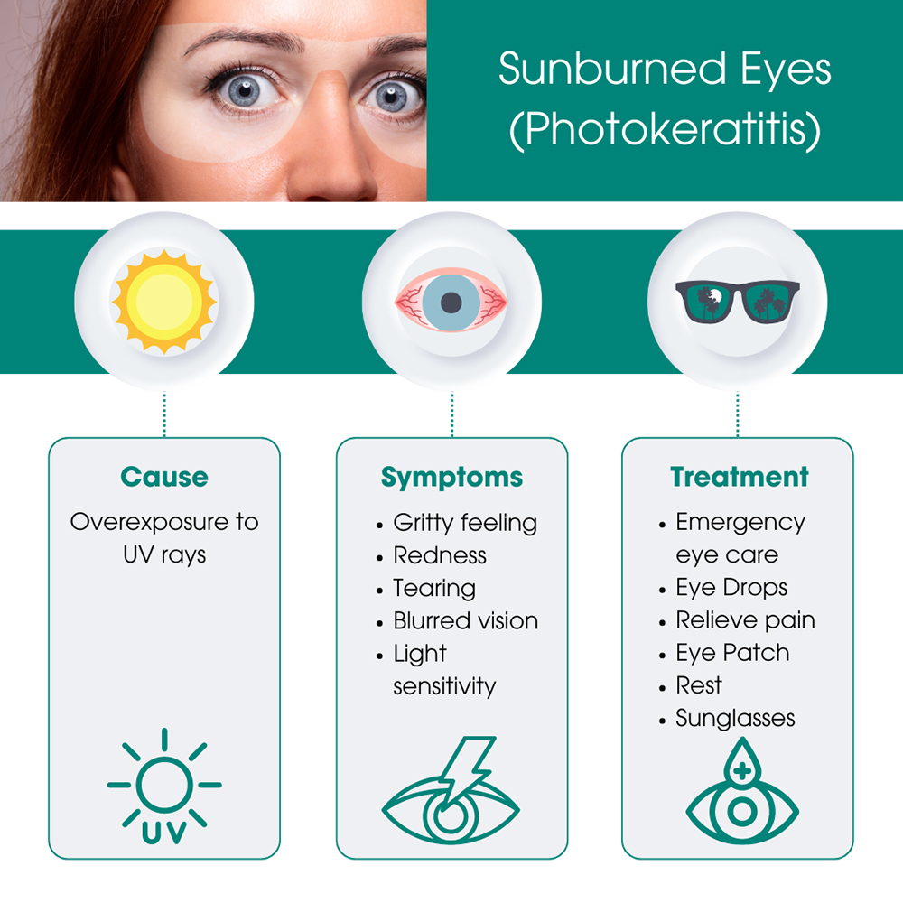 Sunburned Eyes (Photokeratitis)