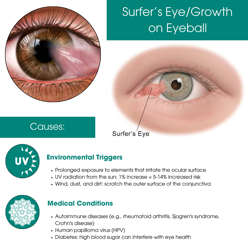 Surfer's Eye Specialist NYC | Eye Physicians Downtown Manhattan