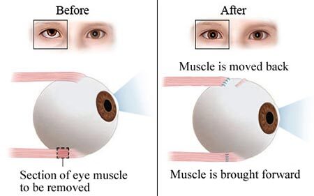 Lazy Eye Surgery