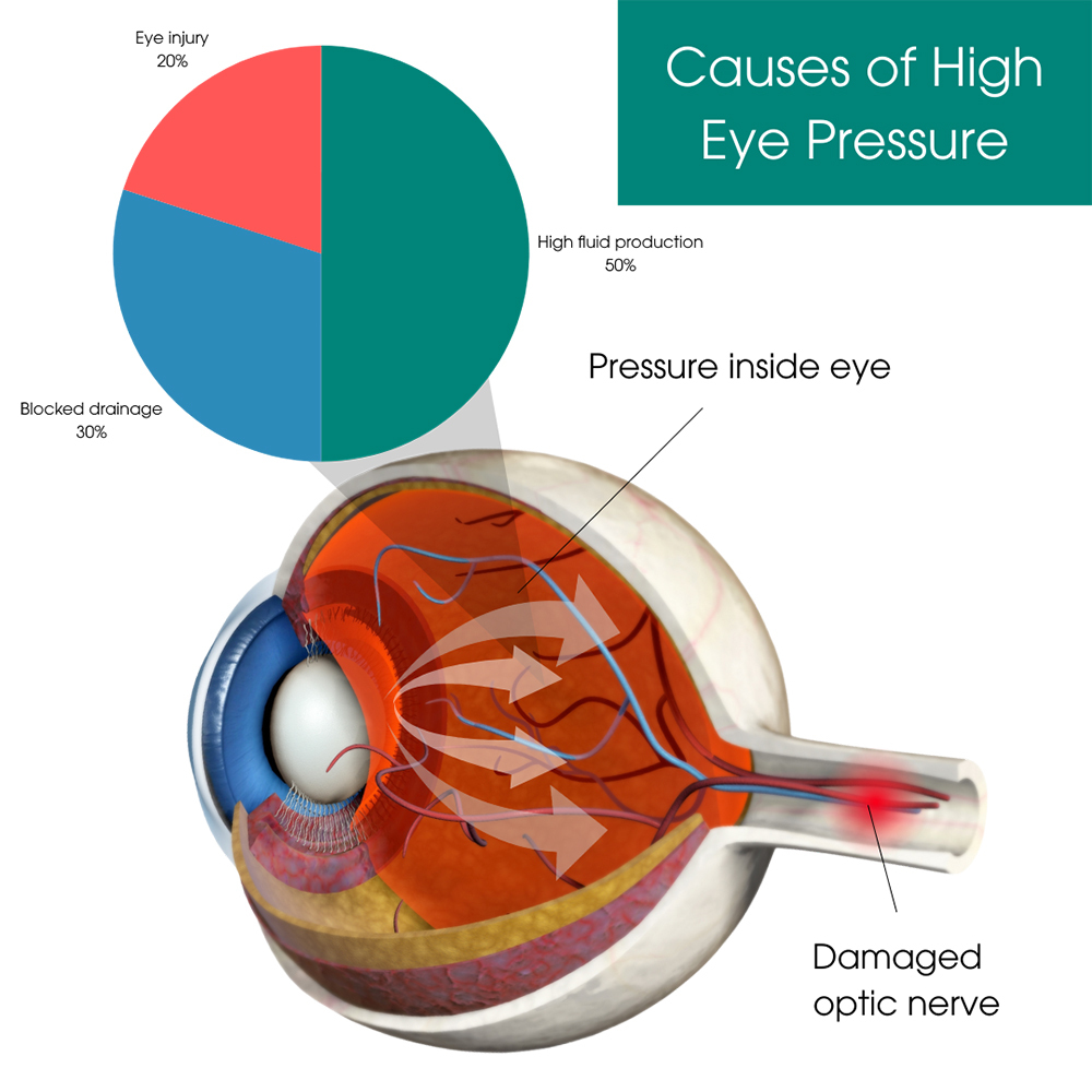 Causes High Eye Pressure