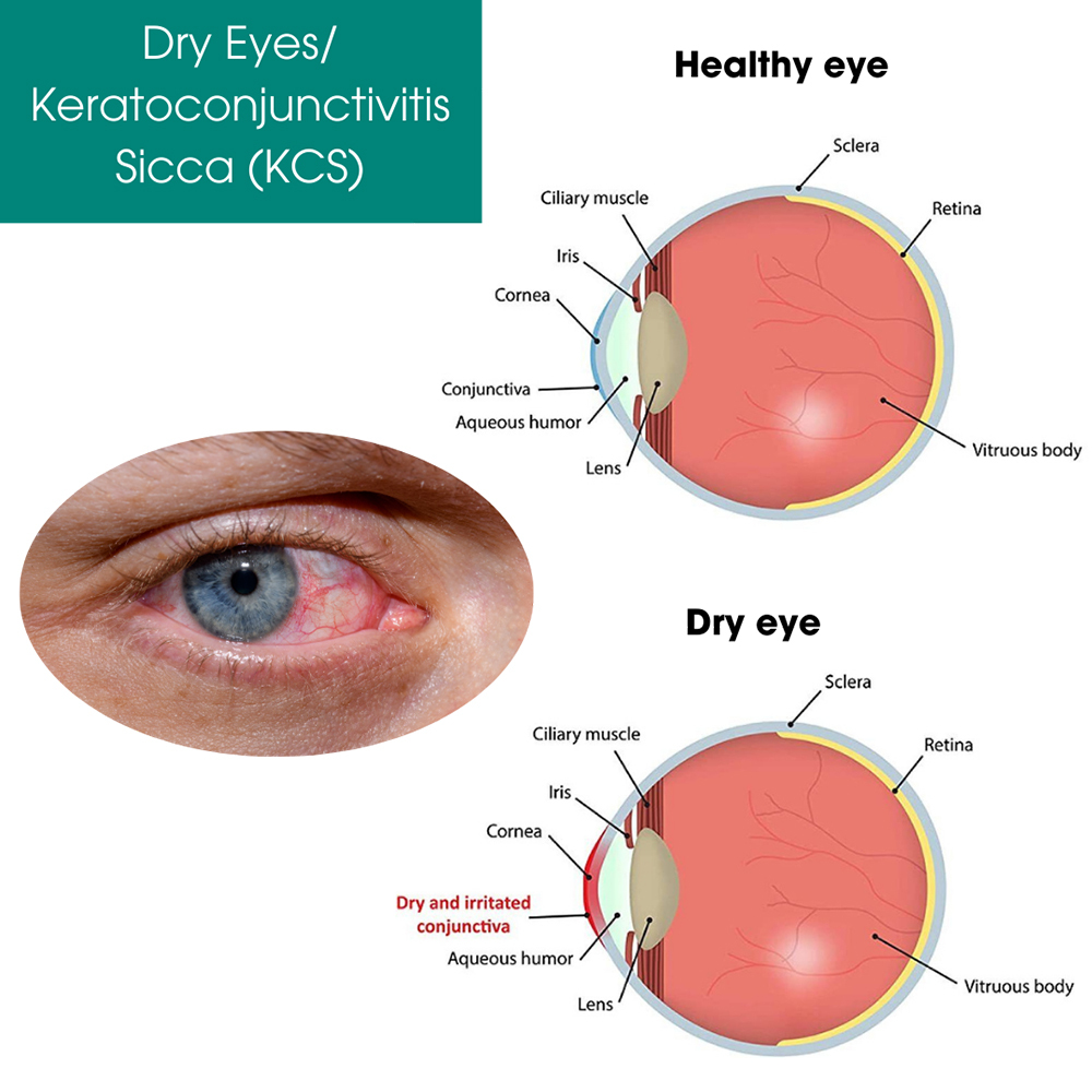 Dry Eyes Treatment