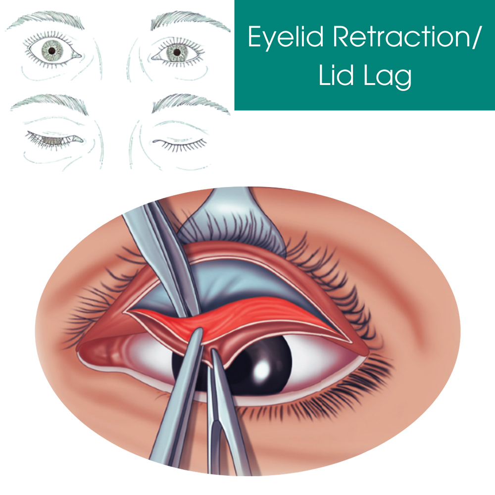 Eyelid Retraction/Lid Lag