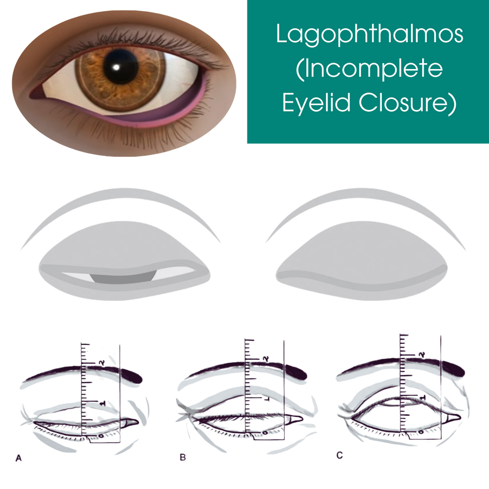 Lagophthalmos (Incomplete Eyelid Closure)