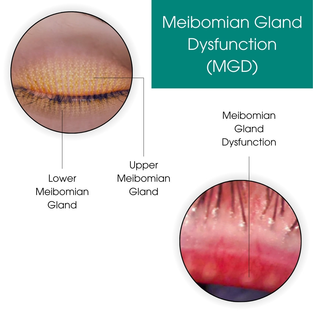 Meibomian Gland Dysfunction