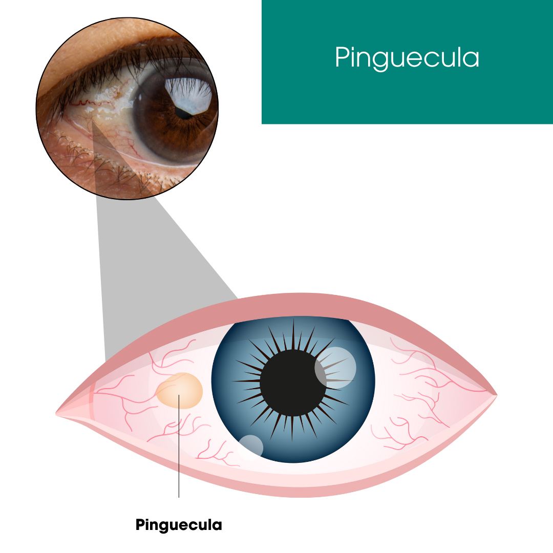 Pinguecula