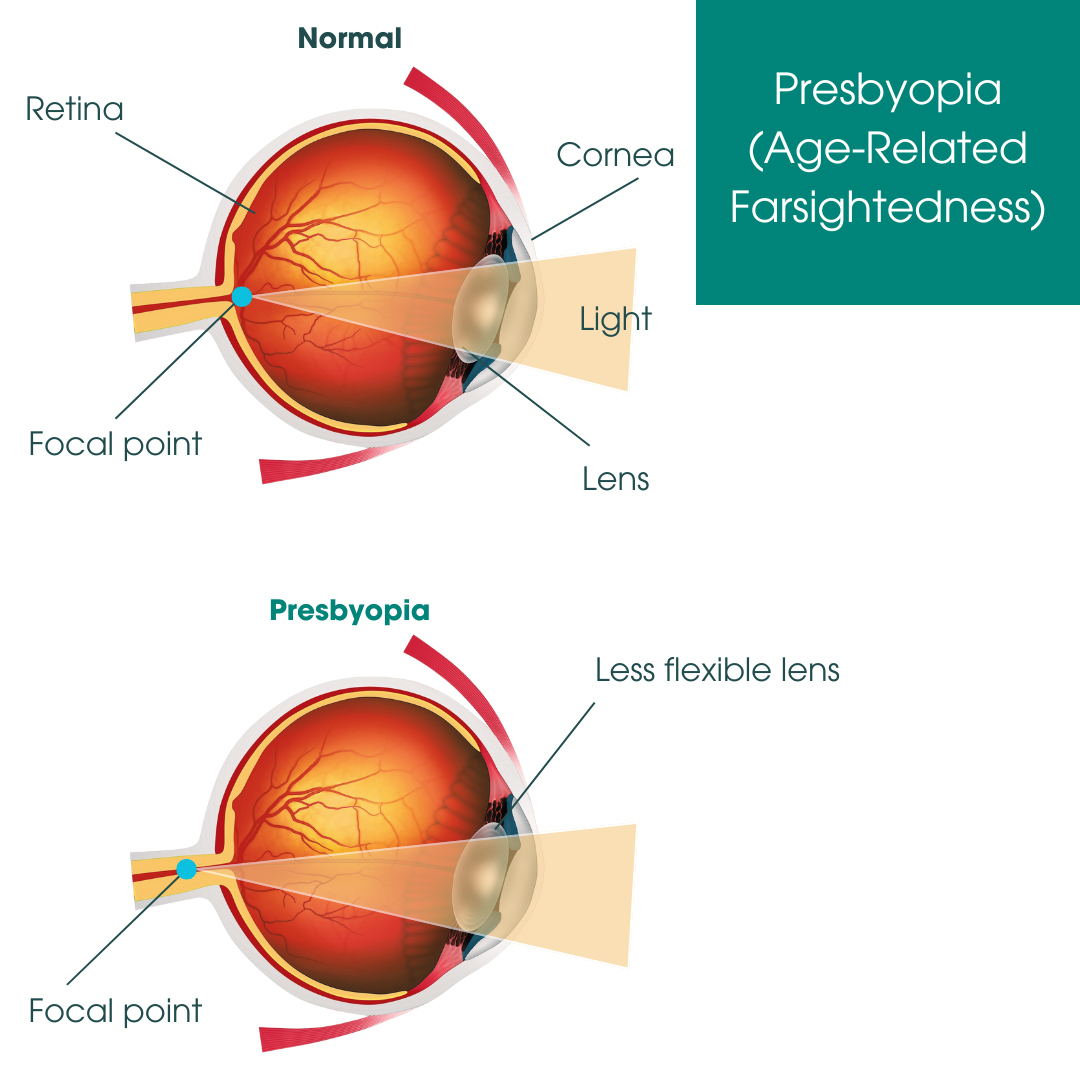 Presbyopia (Age-Related Farsightedness)