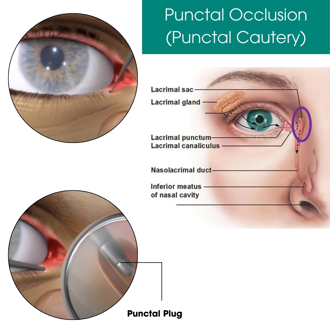 Punctal Occlusion (Punctal Cautery)