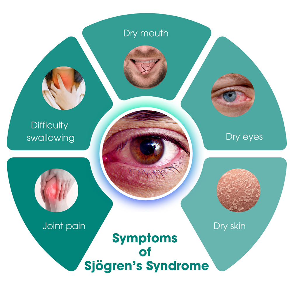 Symptoms of Sjögren’s Syndrome